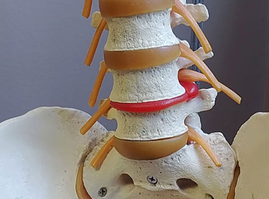 escultura da coluna representa hernia de disco lombar
