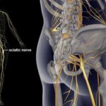 Dor no nervo ciático – o que fazer?